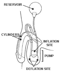 penile implant