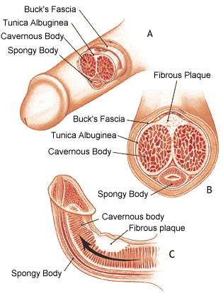 peyronies disease